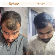 4- Month Visible Hair Growth Plan (100ml × 4) Best Value Pack